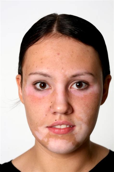 Dementia And Paranoia Treatment Skin Condition Vitiligo Treatment