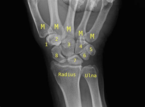 Radiology Studies X Ray Hand Surgery Source