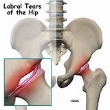 Labral Tear Shoulder Treatment Options Images