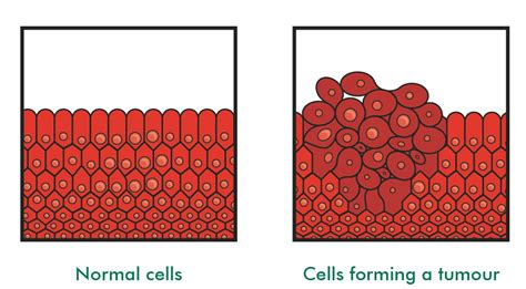 Until relatively recently, experts believed the answer was no. What is a primary brain tumour? - Understanding cancer ...