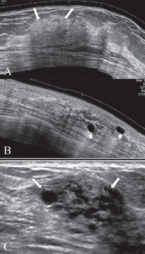 Fibrocystic Change Concise Medical Knowledge