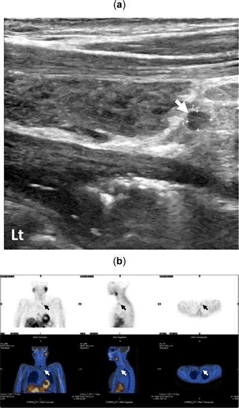 Parathyroid Adenoma Identified By Ultrasound Scan Measuring 26 × 21