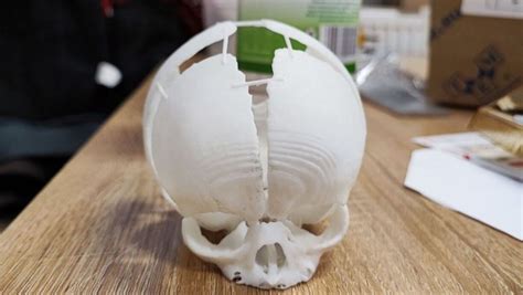 3d Printed Skull Saves Newborn With Exposed Brain