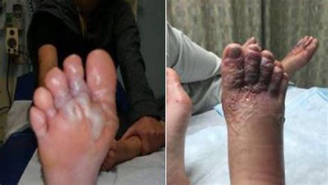 Couple Gets Parasitic Hookworms In Feet After Walking On Caribbean Beach