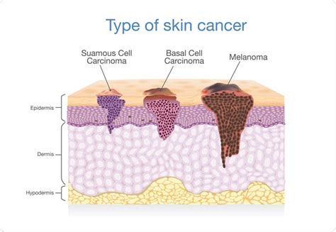 Dermasensors The Future Of Skin Cancer Detection Regenerative