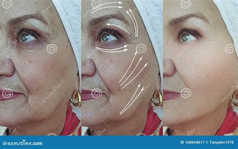 Woman Face Removal Collagen Saggy Wrinkles Tension Regeneration