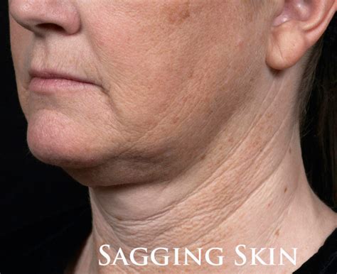 Sagging Skin Coastal Valley Dermatology