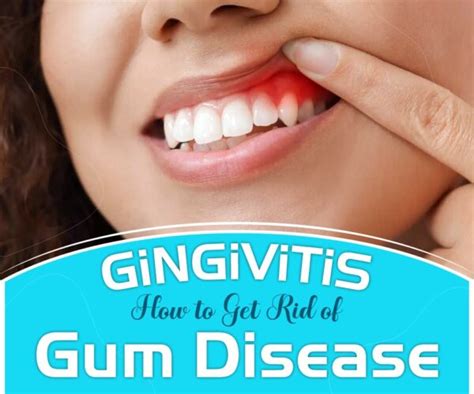 Gingivitis How To Get Rid Of Gum Disease Evoking Minds