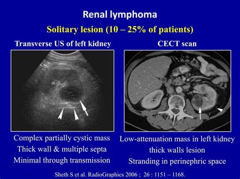 Ultrasound Of The Urinary Tract Renal Tumors