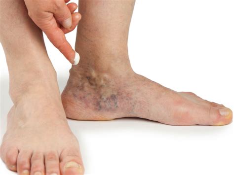 Things You Should Know About Bleeding Varicose Veins All