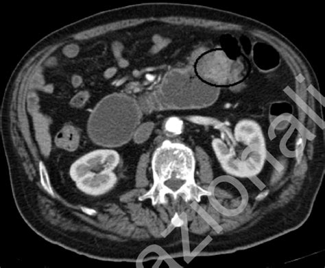 Abdominal Ct With Contrast Shows Iii Iv Portion Of Duodenum With Wall