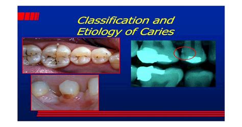 Classification And Etiology Of Caries Review Pdf Document
