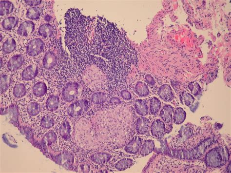 Pathology Outlines Granulomatous Colitis