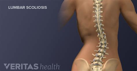 All About Degenerative Scoliosis