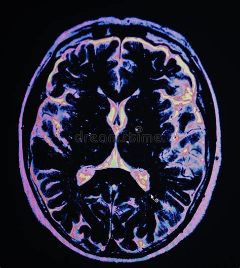 Mri Brain Stroke Stock Image Image Of Anatomical Confusion 52527959