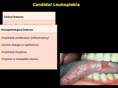 Leukoplakia