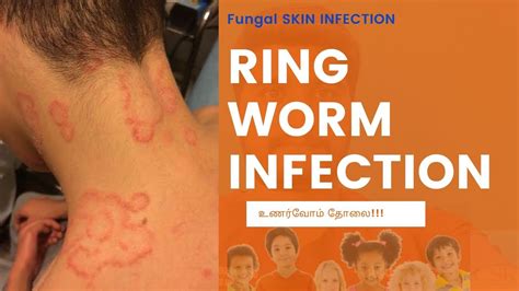 உணர்வோம் படர்தாமரை Tinea Corporisringwormfungal Infection 3