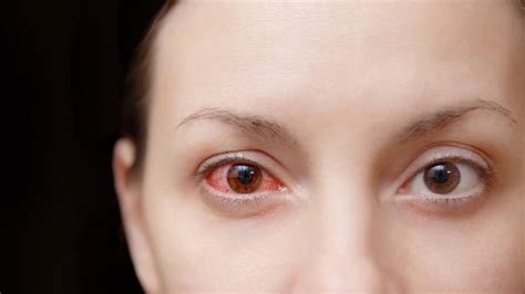 What about design and usability? What Causes Pink Eye, and How Do You Get Rid of It? | Allure