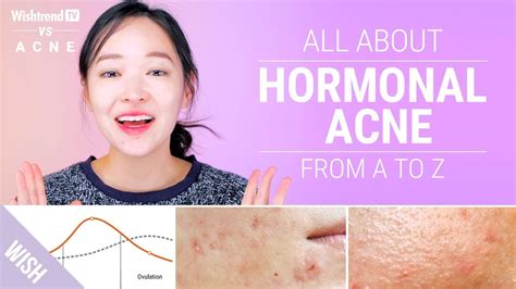 How To Cure Hormonal Acne Lifestyle And Skincare Tips Wishtrend Tv