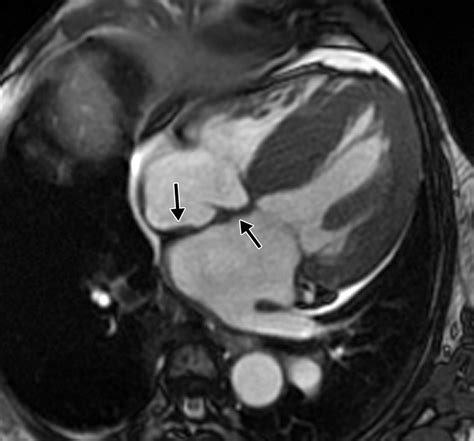 Ct And Mr Imaging Findings In Patients With Acquired Heart Disease At