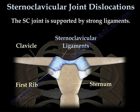 Sternoclavicular Joint Dislocations Everything You Need To Know Dr