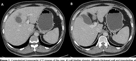 Figure 1 From Primary Hepaticobiliary Tuberculosis Mimicking Gall