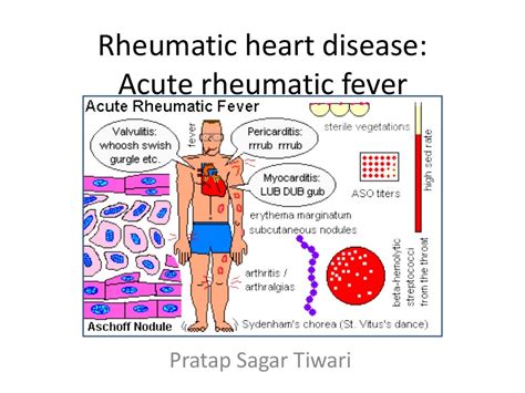 Rheumatic Heart Disease Acute Rheumatic Fever