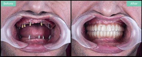Dental Implants Burntwood Teeth Implant