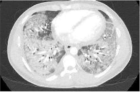Axial Sections Of Ct Chest Showing Diffuse Bilateral Ground Glass