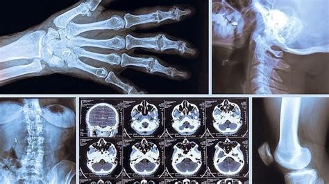 Una De Cada Tres Radiografías No Sirve Para Nadafuente El Correo ~ Auxiliar De Enfermería