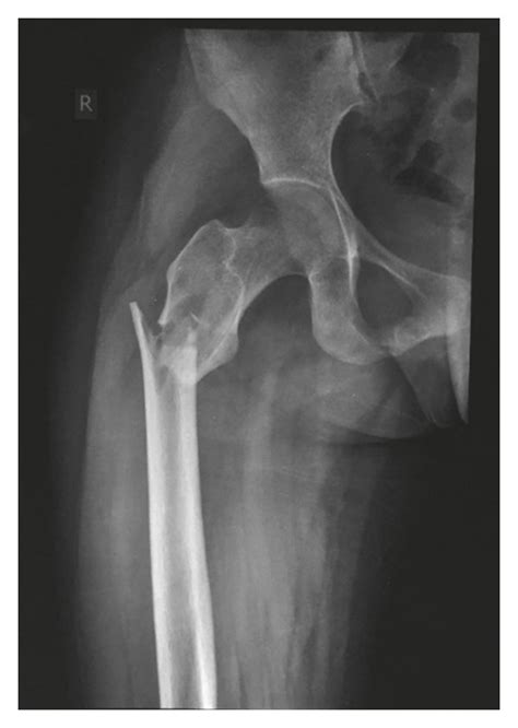 X Ray Showing The Right Subtrochanteric Fracture Download Scientific