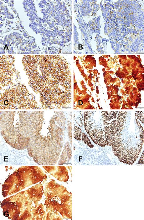 Primary Neuroendocrine Carcinoma Combined With Squamous Cell Carcinoma