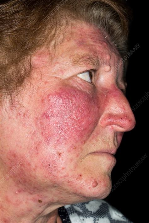 Acne Rosacea Stock Image C0345614 Science Photo Library