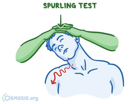 Spurling Test Osmosis