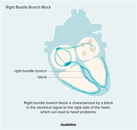 Right Bundle Branch Block Symptoms Causes Diagnosis Treatment In