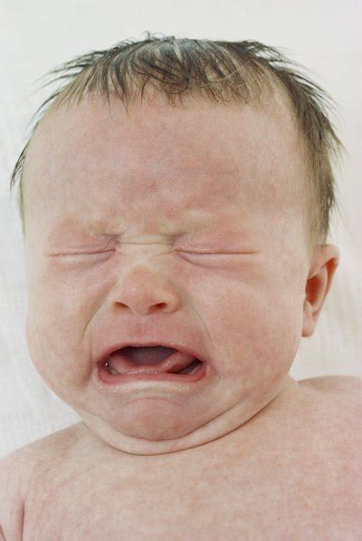 Blotchy Skin Rash On A Babys Face Livestrongcom