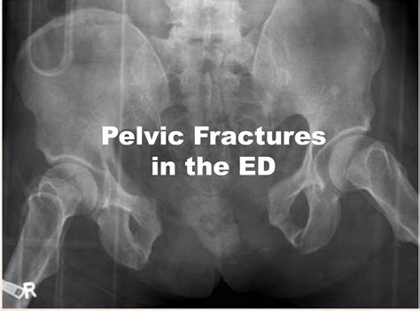 Emergency Medicine Educationpelvic Fractures Ed