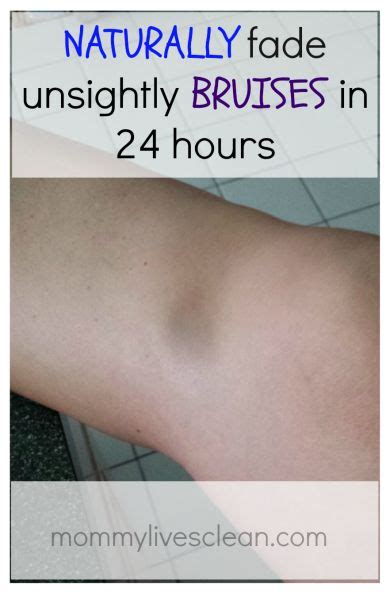 7 Diy Self Care Ideas The Sits Girls Heal Bruises Faster Heal