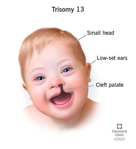 Trisomy Patau Syndrome Pictures Hot Sex Picture