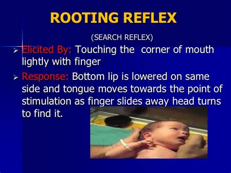 Neonatal Reflexes Dnb Pediatrics