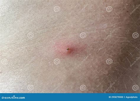 Close Up Of A Tick Embedded In A Personskin At The Site Of The Bite