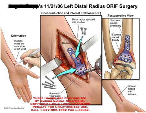 Amicus Illustration Of Amicus Surgery Distal Radius Orif Open Reduction Internal Fixation