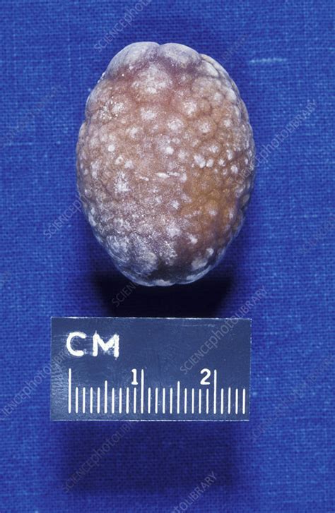 Gallstone Stock Image M1650239 Science Photo Library