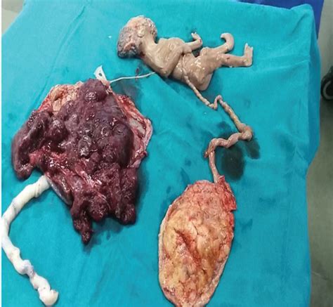 It stays in uterus and starts getting putrefied. Maternal and neonatal outcome of surviving twin after ...