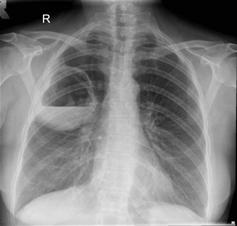 Cavitating Lung Lesion Radiology Case