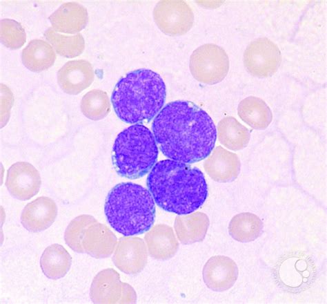 Precursor B Cell Acute Lymphoblastic Leukemia 2