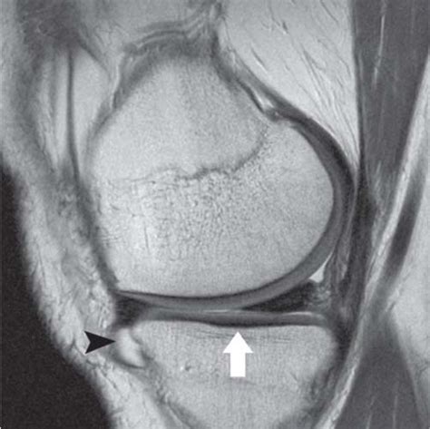 Articular Cartilage Radiology Key