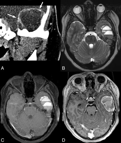 Ct And Mr Imaging Findings In A Patient With An Aneurysmal Bone Cyst Download Scientific