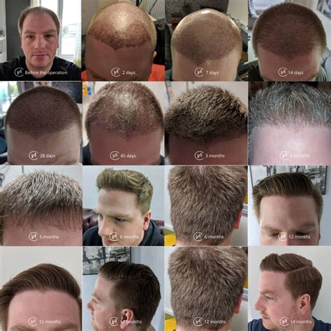 Details Hair Transplant Month By Month Latest In Eteachers