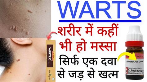 Homeopathic Medicine For Warts Warts Treatment Without Surgery Warts